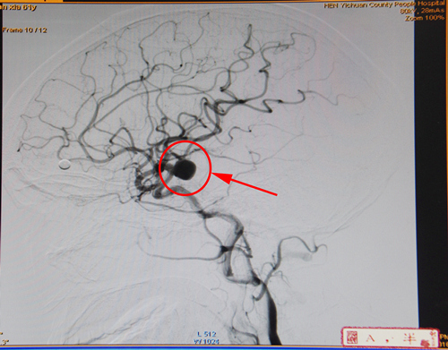 3术前脑血管造影显示右侧后交通处巨大动脉瘤副本_副本.jpg